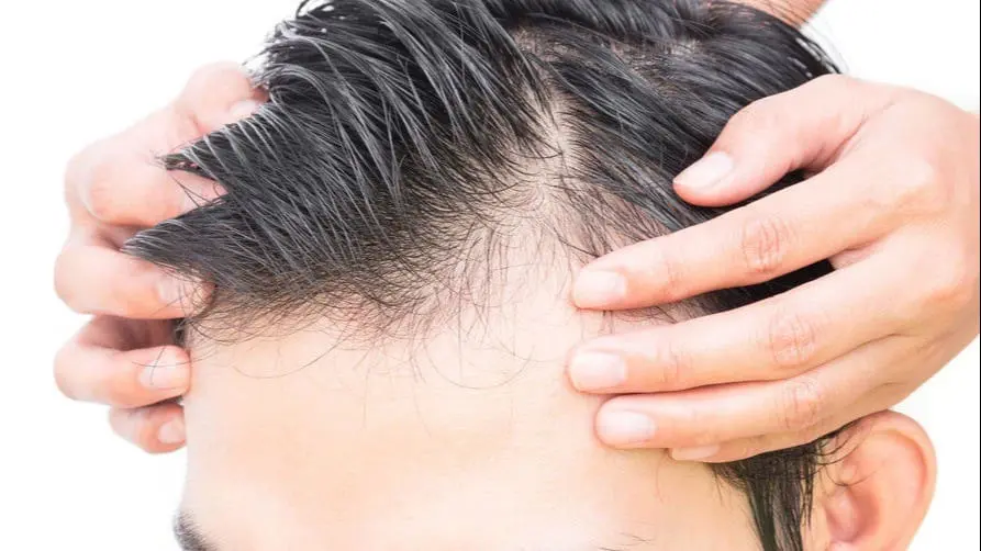 掉髮 & 雄性禿門診