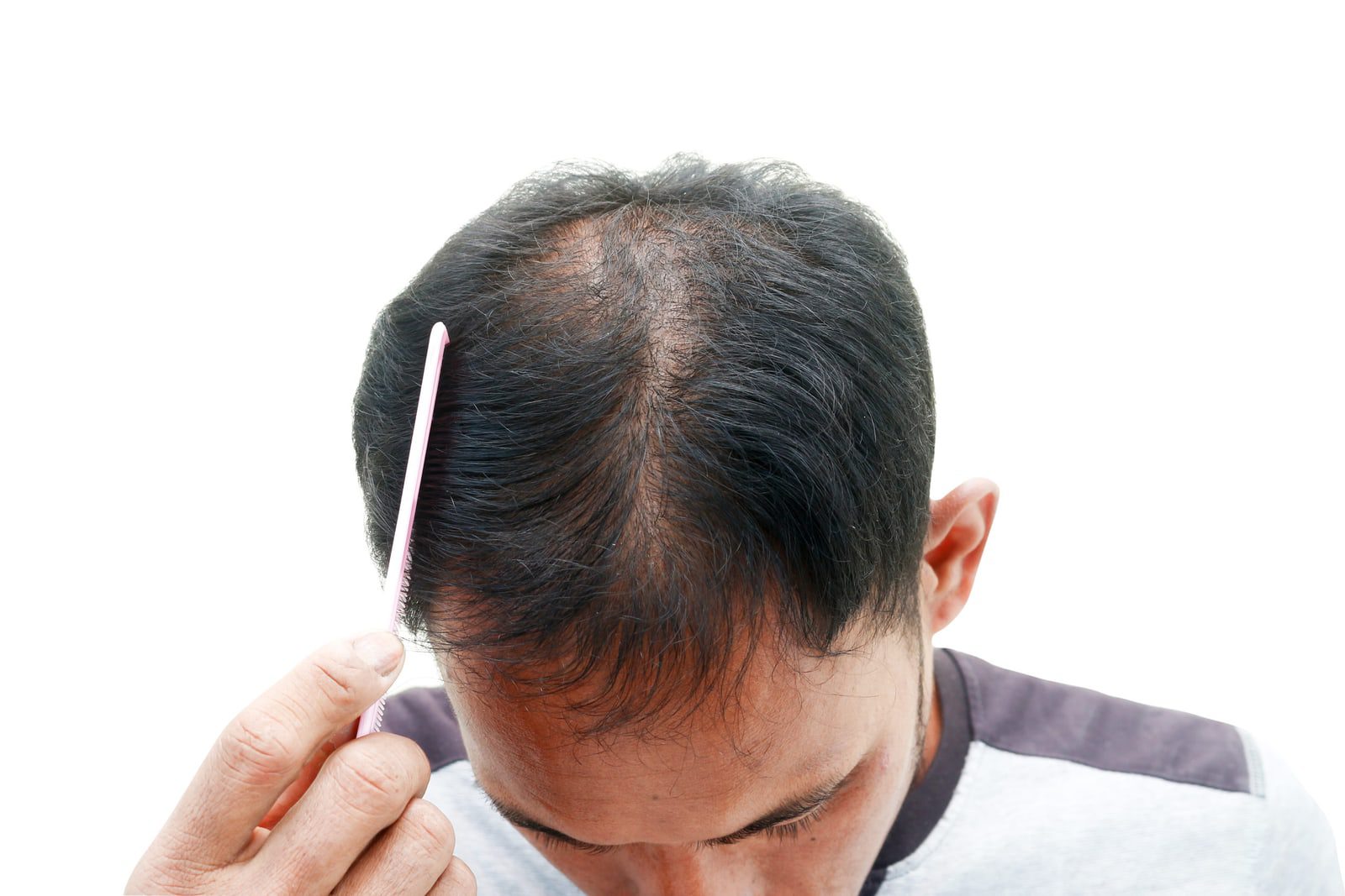 男性型掉髮外用與口服治療評估 6