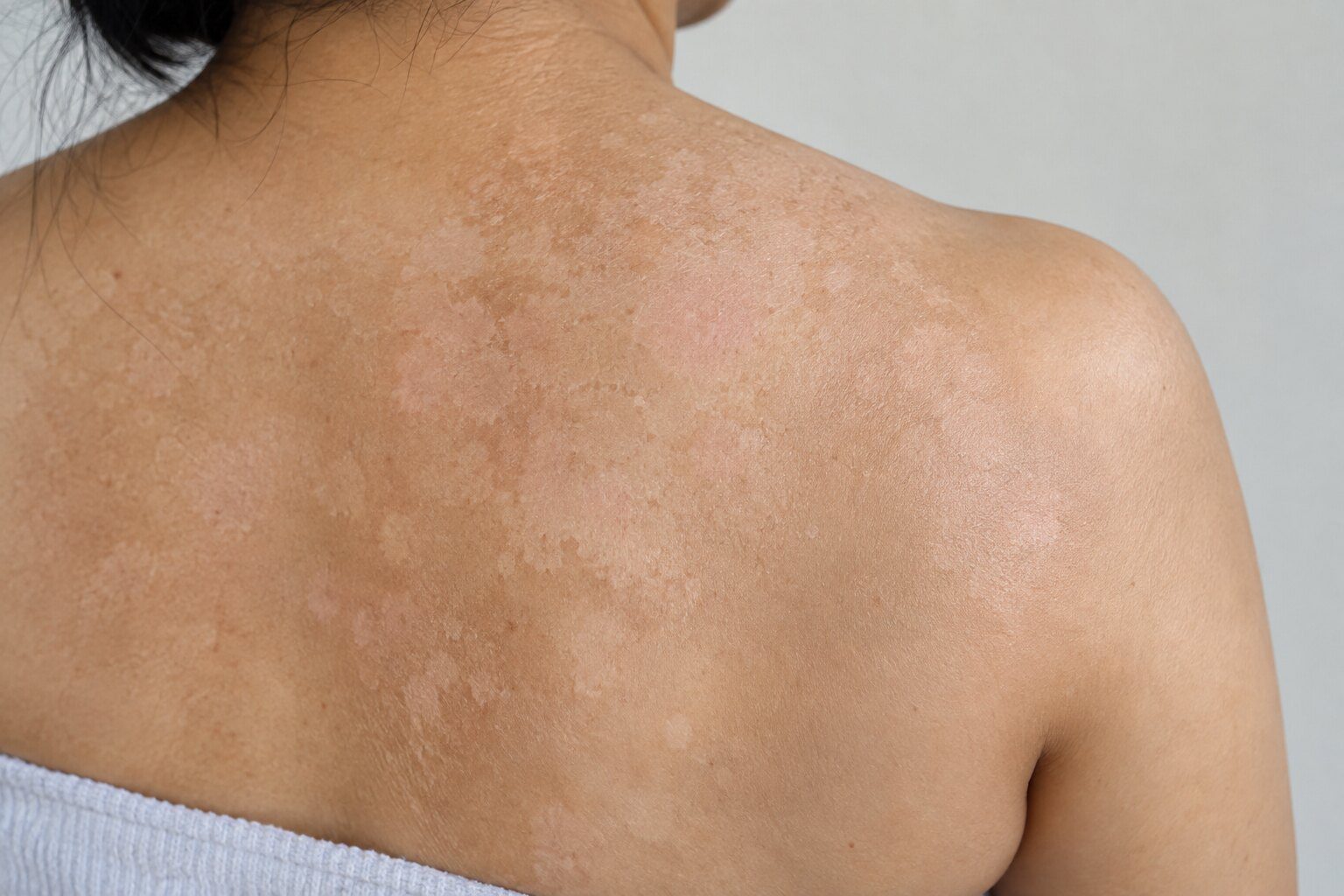 Tinea versicolor symptoms dermatology assessment and daily care 2